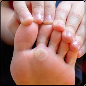 درمان تاول پا در پیاده روی